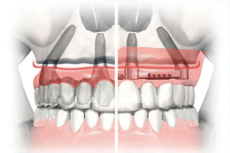All On Four Dental Impalants treatment concept in Maryland MD