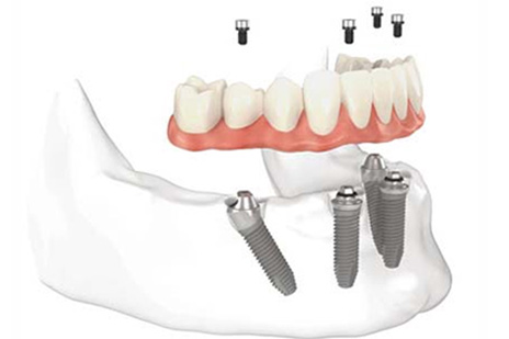 All On Four Dental Impalants treatment concept in Baltimore