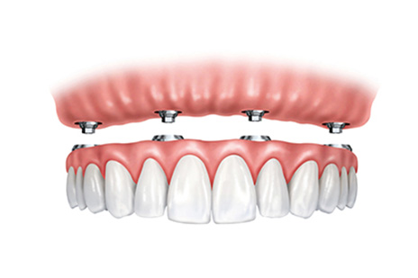All On Four Dental Impalants treatment concept in Maryland MD