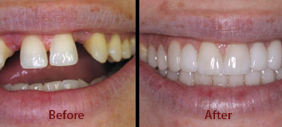 before after pictures for dental implant
