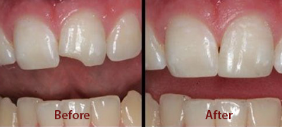 Dental Care Before After Pictures