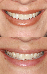 Invisalign in Maryland MD Baltimore