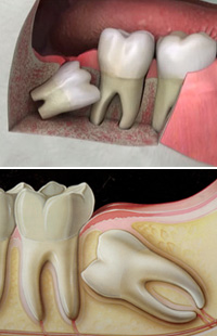 Wisdom Tooth Removal Maryland MD